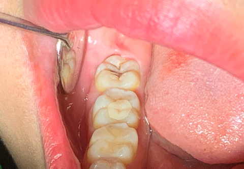 7 biến chứng sau khi nhổ răng khôn bạn phải biết